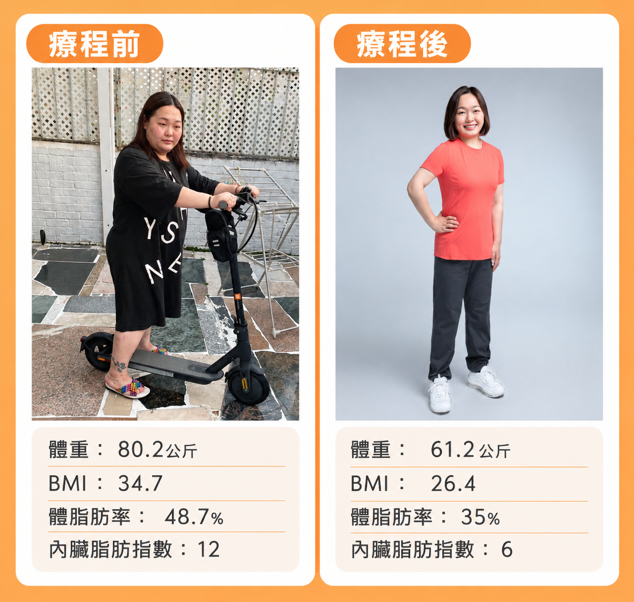 荷爾蒙失調肥胖治療前後對比，體重由80.2公斤降至61.2公斤